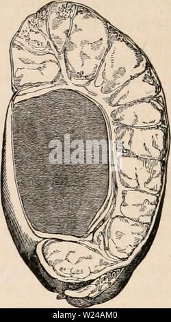 Immagine di archivio da pagina 223 della encyclopaedia - Wikizionario di anatomia e. Il encyclopaedia - Wikizionario di anatomia e fisiologia cyclopdiaofana0402todd Anno: 1849 1008 testicolo (Anatomia anormale). siderable compattezza e consistenza ; la tunica albuginea è addensato, e in alcuni luoghi come densi e indurated come la cartilagine ; e le superfici della tunica vaginalis sono strettamente collegati da vecchio adesioni. La struttura ghiandolare è parzialmente spostato e atrofizzati dalla pressione della materia gialla ; e spesso capita qualche tempo dopo che entrambi sono sottoposti ad un lento processo di perdere, in modo che una vista ingrandita e indurated gla Foto Stock