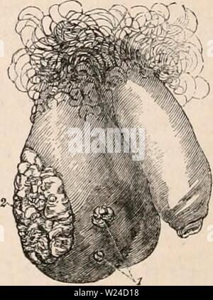 Immagine di archivio da pagina 229 della encyclopaedia - Wikizionario di anatomia e. Il encyclopaedia - Wikizionario di anatomia e fisiologia cyclopdiaofana0402todd Anno: 1849 di un uomo nero, affetti da elephantiasis, preso dal dott. Titley sul lavoro ' malattie dei genitali, nel maschio,' il tumore de- scended quasi alle caviglie. Elephantiasis dello scroto è una affezione morbosa dei tegumenti, analogo all'allargamento delle estremità comunemente noto con il nome di gamba Barbadues ; con il quale, infatti, in quei paesi in cui la malattia è prevalente, è suscettibile di essere com- binata. Elephantiasis dello scroto, Foto Stock