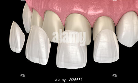 Impiallacciatura di procedura di installazione più incisivo centrale e incisivo laterale. Accurata dal punto di vista medico dente 3D illustrazione Foto Stock