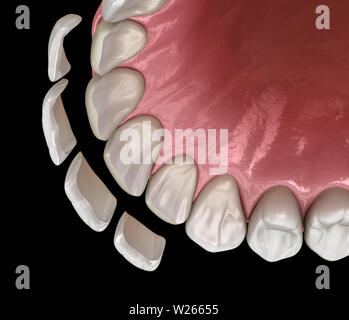 Impiallacciatura di procedura di installazione più incisivo centrale e incisivo laterale. Accurata dal punto di vista medico dente 3D illustrazione Foto Stock