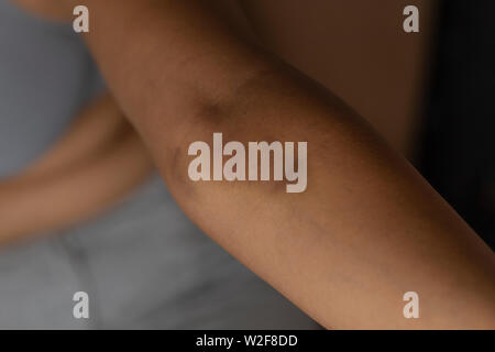 Lividi sul braccio di una donna - Problema della pelle sul braccio. Foto Stock