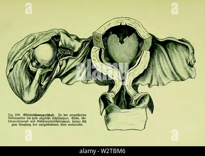 Die Frau als Hausärztin (1911) 198 Eileiterschwangerschaft Foto Stock