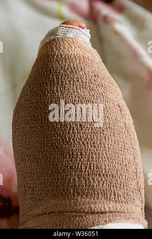 Secondo giorno dopo un bunion e chirurgia hammertoe sul piede destro di una donna nel suo 60's. Il piede bendato e rigonfiato. Foto Stock