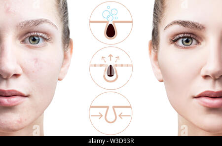 Mostra graficamente come inquinare e pulire i pori sulla faccia. Maggiore area della pelle con blackhead. Foto Stock