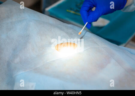 Mole di distacco. Close-up della schiena del paziente è coperto con un panno sterile sul tavolo operatorio. Posto di operazione sterilizzati. Foto Stock