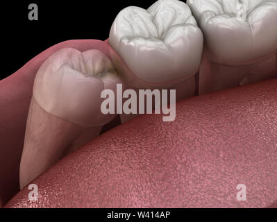 Denti sani e dente di saggezza con impatto mediale . Accurata dal punto di vista medico dente 3D illustrazione Foto Stock