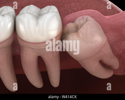 Denti sani e dente di saggezza con impatto mediale . Accurata dal punto di vista medico dente 3D illustrazione Foto Stock