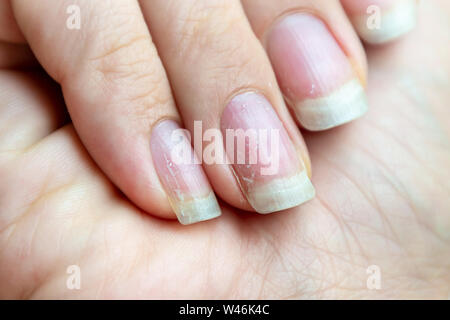 Danneggiato i chiodi che hanno il problema dopo aver fatto manicure. Salute e bellezza problema. Foto Stock