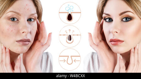 Mostra graficamente come inquinare e pulire i pori sulla faccia. Foto Stock