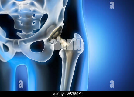 Articolazione artificiale dell'anca closeup - 3D illustrazione Foto Stock