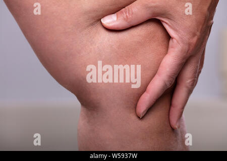 Una persona del ginocchio con vene varicose e capillari prima e dopo il trattamento medico Foto Stock