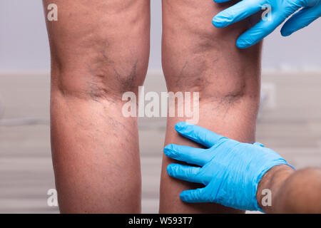 Medic con lattice blu guanti chirurgici toccando le vene varicose sulla gamba del paziente Foto Stock