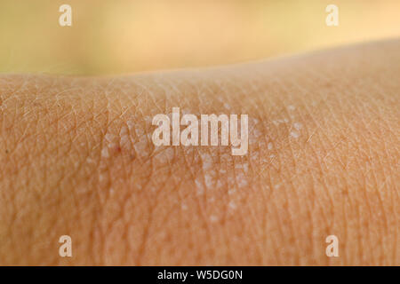 Le vesciche sulla pelle umana sulla mano da scottature close-up. Macro. Foto Stock