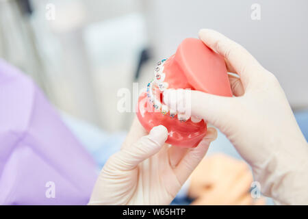 Dentista mostra rinforzi su un modello di protesi prima del trattamento come un esempio Foto Stock