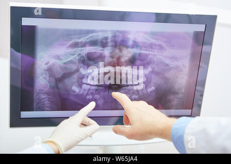 Le mani di dentisti punto di immagine a raggi x della dentiera su un monitor nella diagnostica Foto Stock