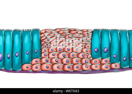 La metaplasia epiteliale, illustrazione del computer. La metaplasia è una variazione del tipo di cellula in una regione. Questa illustrazione mostra la metaplasia squamosa di epitelio respiratorio, una conseguenza del fumo di sigaretta. Foto Stock