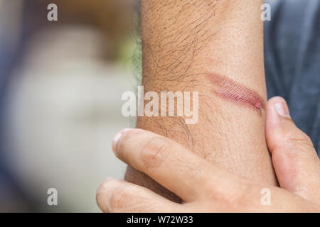 Chiudere la masterizzazione di pelle sul braccio, lesioni personali causate da incendi Foto Stock