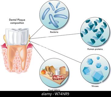 Illustrazione medica della composizione della placca dentale Illustrazione Vettoriale