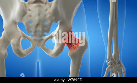 3D Rendering accurato dal punto di vista medico illustrazione di un artritico hip joint Foto Stock