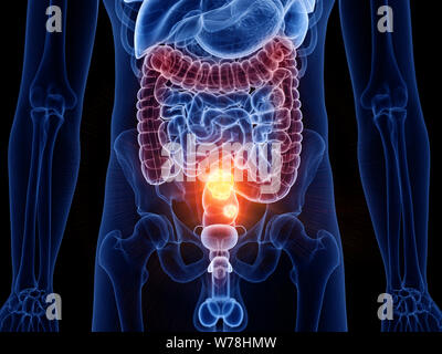 3D Rendering accurato dal punto di vista medico illustrazione di cancro al colon Foto Stock