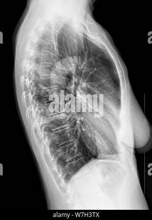 Raggi X del torace della donna il Venerdì, 26 luglio 2019. (© Francesca M. Roberts) Foto Stock