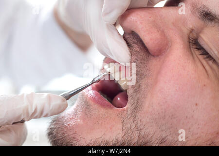 La punta dell'escavatore non tocca il gioco tra i denti durante la ispezione dentale. Il volto di un uomo bianco con luce stoppia giace sulla sedia duri Foto Stock