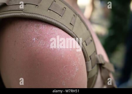 Spalla bruciata dal sole con uno zaino cinturino di close-up. Scottature della pelle. Foto Stock