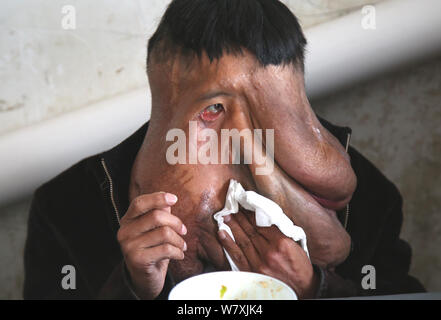 "La Cina Elephant Man' Huang Chuncai, 41, chi soffre di 15kg tumore enorme sulla faccia, salviettine la sua bocca dopo aver mangiato il pranzo a casa nel villaggio di Yulan, Foto Stock