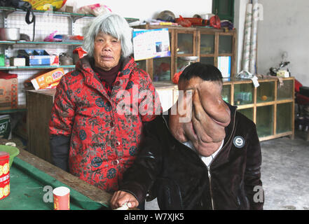 "La Cina Elephant Man' Huang Chuncai, 41, chi soffre di 15kg enorme tumore sul viso, e sua madre sono ritratte in casa di villaggio Yulan, Yongxi Foto Stock