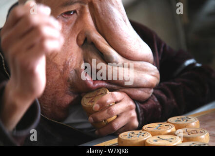 "La Cina Elephant Man' Huang Chuncai, 41, chi soffre di 15kg tumore enorme sulla faccia, gioca a scacchi cinesi con gli abitanti di un villaggio a casa nel villaggio di Yulan, Foto Stock