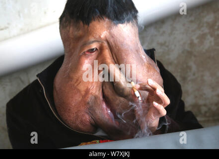 "La Cina Elephant Man' Huang Chuncai, 41, chi soffre di 15kg enorme tumore sul viso, fuma una sigaretta a casa nel villaggio di Yulan, Yongxing county Foto Stock
