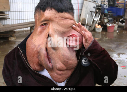 "La Cina Elephant Man' Huang Chuncai, 41, chi soffre di 15kg tumore enorme sulla faccia, è raffigurato a casa nel villaggio di Yulan, Yongxing county, Chenz Foto Stock