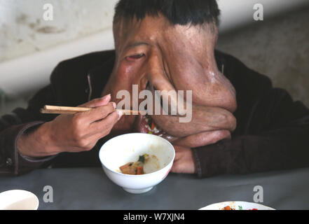 "La Cina Elephant Man' Huang Chuncai, 41, chi soffre di 15kg enorme tumore sul viso, mangia il pranzo a casa nel villaggio di Yulan, Yongxing county, Chenzh Foto Stock