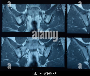 MRI sacroiliac articolazione. Studio della spondilite spondyloarthritis paziente. I risultati dello studio sui raggi x. Foto Stock