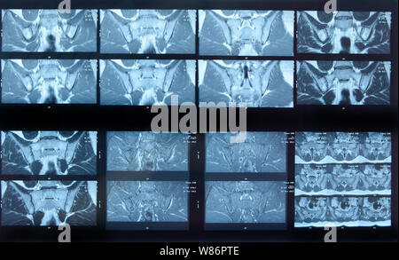 MRI sacroiliac articolazione. Studio della spondilite spondyloarthritis paziente. I risultati dello studio sui raggi x. Foto Stock