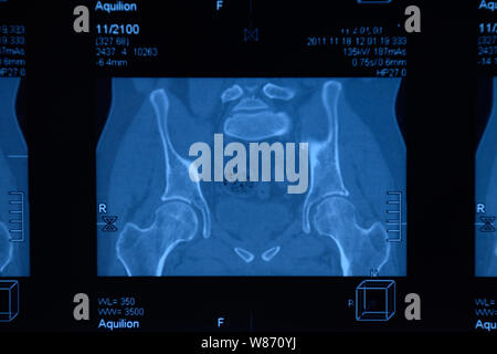 MRI sacroiliac articolazione. Studio della spondilite spondyloarthritis paziente. I risultati dello studio sui raggi x. Foto Stock