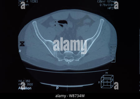 MRI sacroiliac articolazione. Studio della spondilite spondyloarthritis paziente. I risultati dello studio sui raggi x. Foto Stock