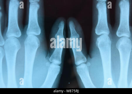 X-ray delle mani, un'immagine delle ossa delle mani sui raggi x. Foto Stock
