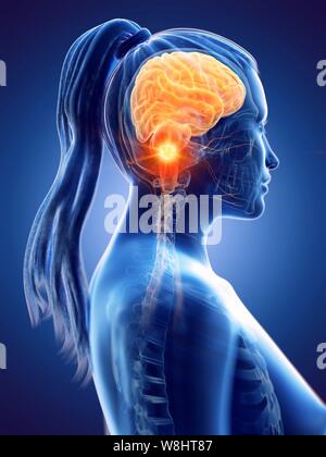 Brain cancer, concettuale illustrazione del computer. Foto Stock