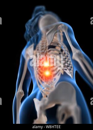 Dolore alla schiena, concettuale illustrazione del computer. Foto Stock