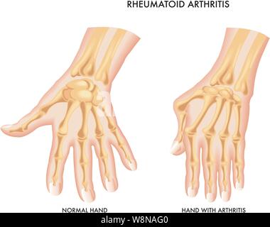 Illustrazione medica dei sintomi di artrite reumatoide della mano. Illustrazione Vettoriale