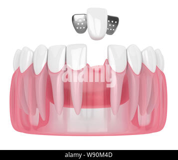 3D render della ganascia con denti e maryland ponte su sfondo bianco Foto Stock