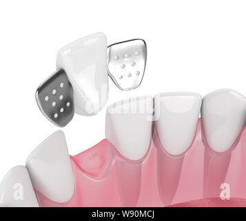 3D render della ganascia con denti e maryland ponte su sfondo bianco Foto Stock