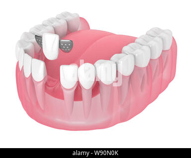 3D render della ganascia con denti e maryland ponte su sfondo bianco Foto Stock