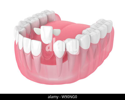 3D render della ganascia con denti e maryland ponte su sfondo bianco Foto Stock