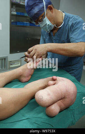 Un medico segna il piedone del giovane ragazzo cinese Xiao uomini prima di un intervento chirurgico in una sala operatoria presso l Ospedale dei Bambini di Shanghai in Shanghai, Chi Foto Stock