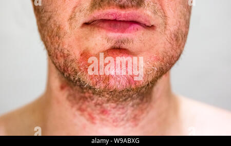 Uomo con dermatite seborroica nell'area della barba Foto Stock