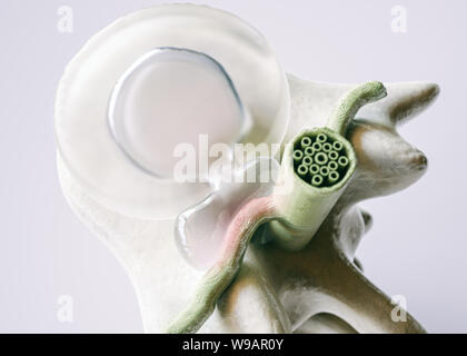 Spinale ernia del disco come close-up dettagliate in 3D Rendering Foto Stock