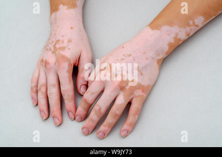 Vitiligine sulla pelle delle mani. Foto Stock