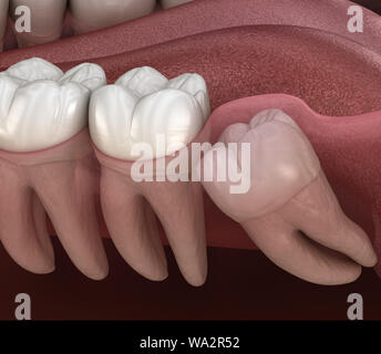 Denti sani e dente di saggezza con impatto mediale . Accurata dal punto di vista medico dente 3D illustrazione Foto Stock